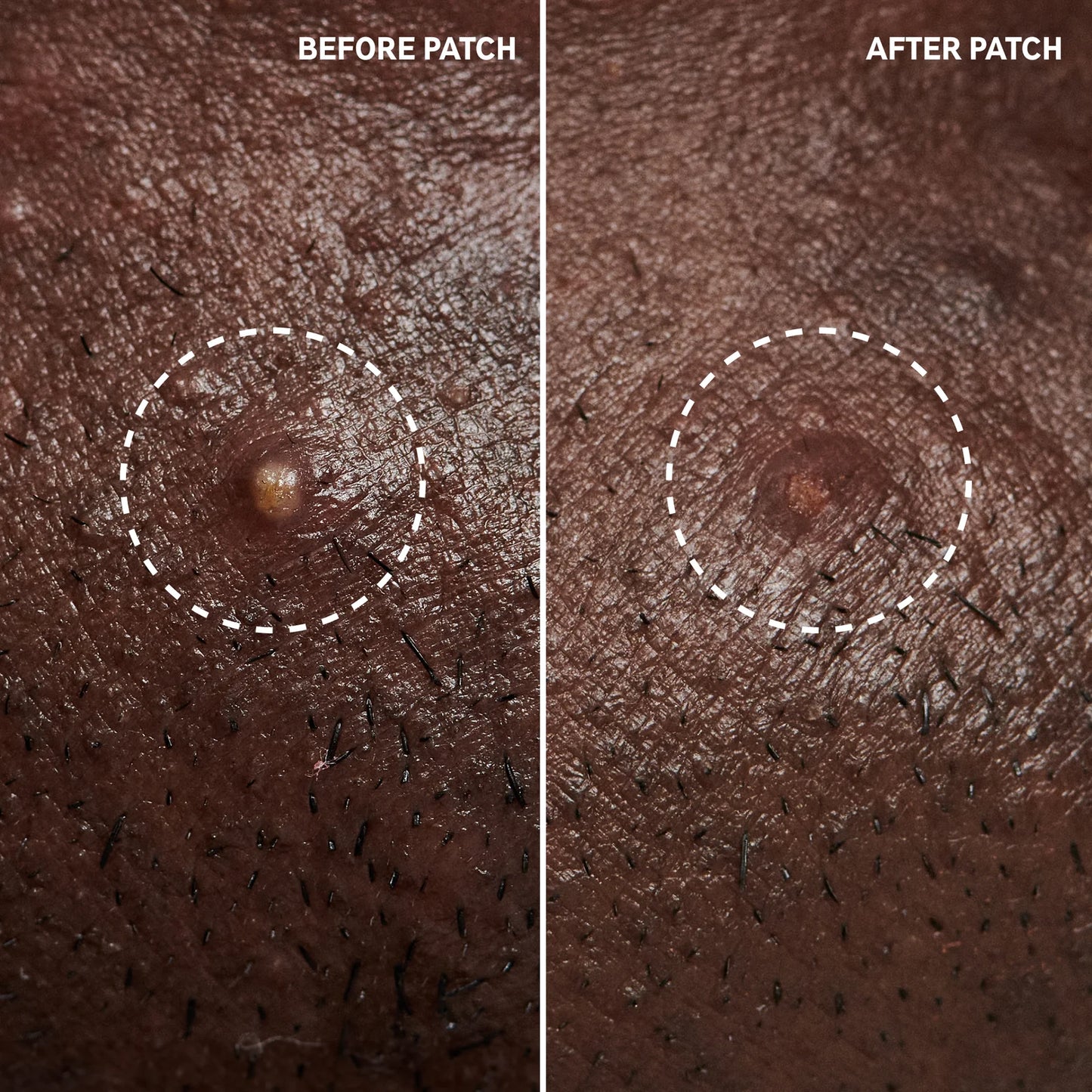 The Inkey List Hydrocolloid Invisible Pimple Patches